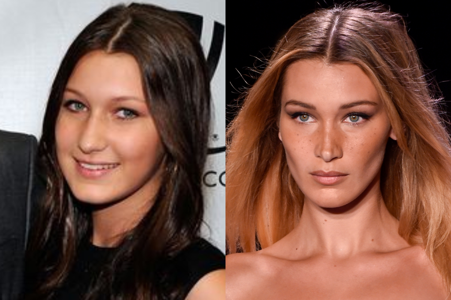 Bella Hadid Plastic Surgery Before And After Who Magazine