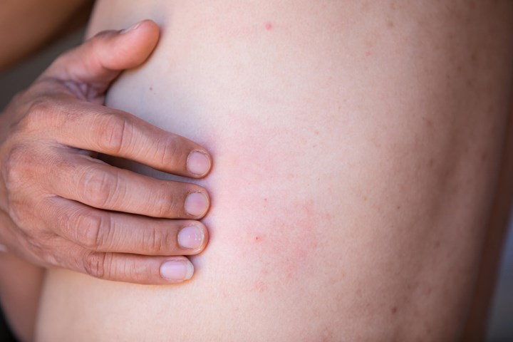 A man scratching a rash on his skin caused by hives