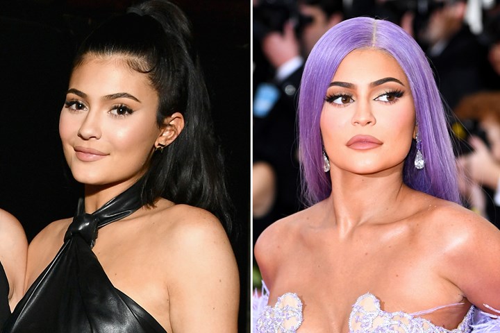 Kylie Jenner Plastic Surgery: Before And After | Who Magazine