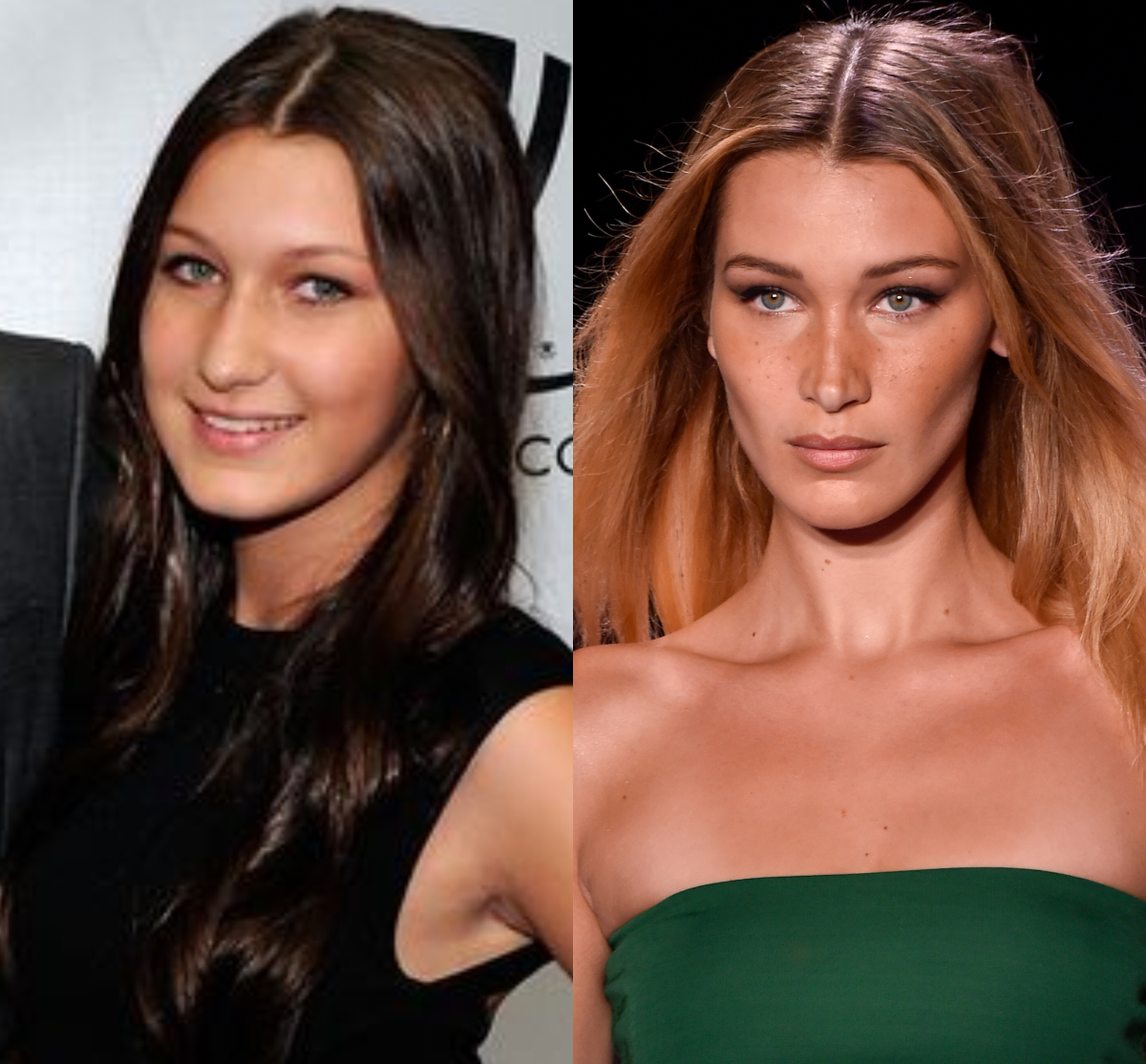 Bella Hadid plastic surgery Before and after WHO
